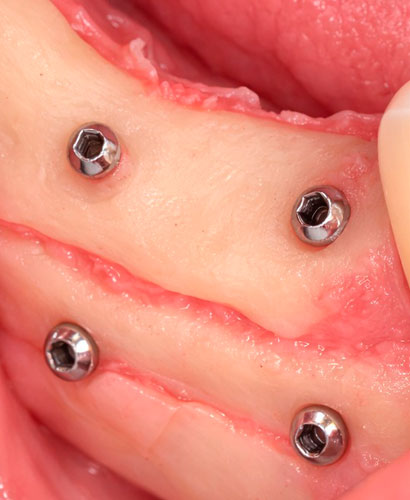 Reconstrucción Ósea 3D – 100% ONLINE