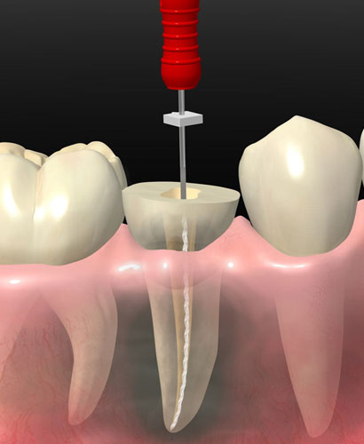 Endodoncia Mecanizada – 100% ONLINE