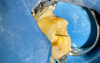 Diplomatura en Endodoncia – 100% ONLINE
