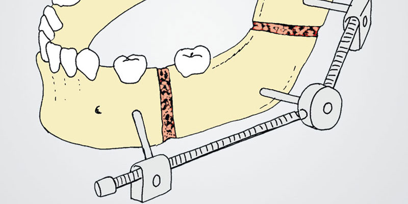 Distracción osteogénica gradual y ortodoncia en alteraciones de las relaciones maxilomandibulares