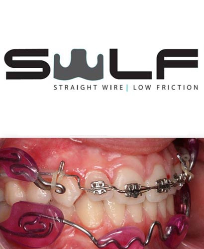 #LecturaRecomendada: Ortodoncia Técnica Straight Wire Low Friction: Nuestra Prescripción