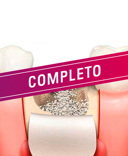 Curso Rehabilitación Oral con Implantes