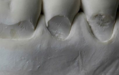 Lesiones Cervicales No Cariosas – 100% ONLINE
