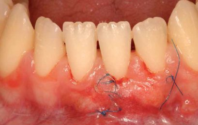 #LecturaRecomendada Cirugía plástica periodontal: Tratamiento de una recesión gingival clase III de Miller mediante técnica bilaminar, injerto de tejido conectivo y amelogeninas