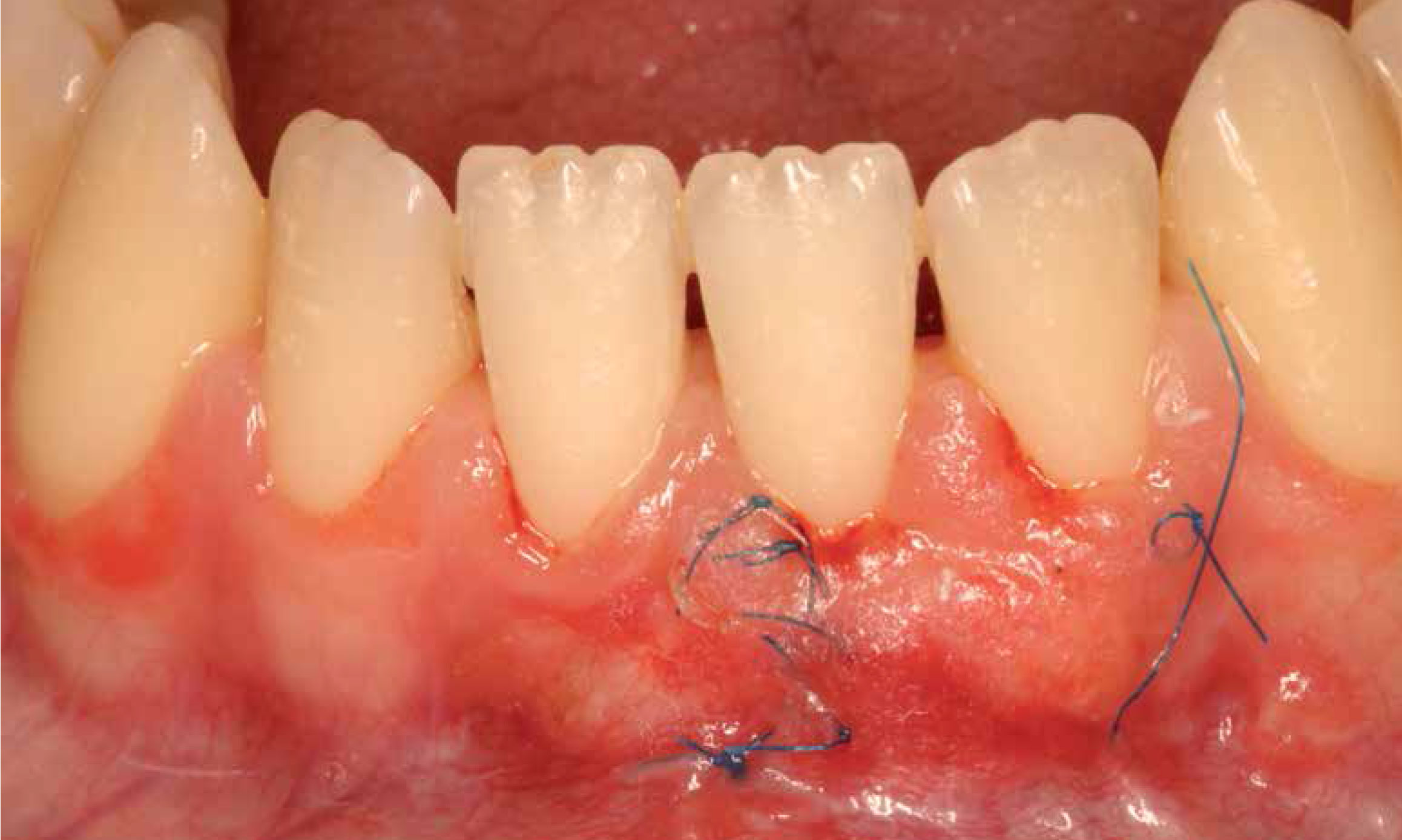 #LecturaRecomendada Cirugía plástica periodontal: Tratamiento de una recesión gingival clase III de Miller mediante técnica bilaminar, injerto de tejido conectivo y amelogeninas