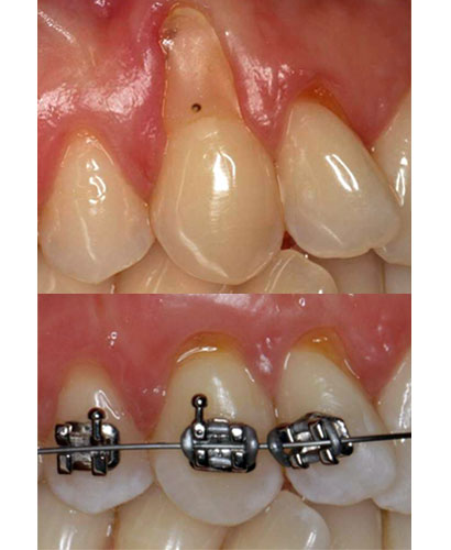 Periodoncia: Cirugía plástica periodontal en áreas estéticas – 100% ONLINE