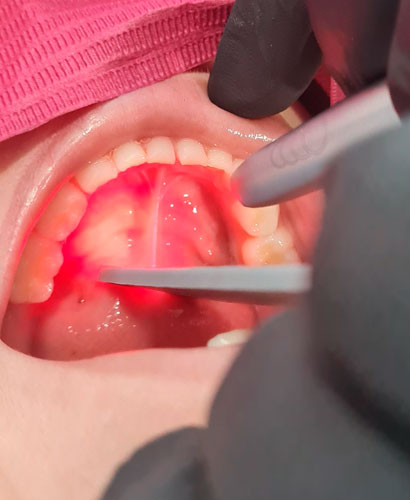 Láser: Simplificando la Odontopediatría – 100% ONLINE
