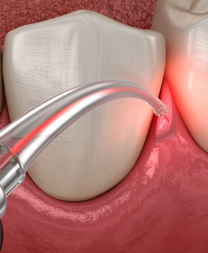 Odontología Láser – 100% ONLINE