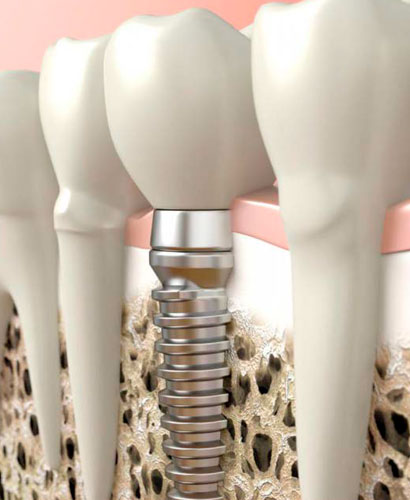 Posgrado en Implantes: Técnicas de Aumento de Volumen Óseo