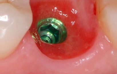 Restauraciones sobre Implantes – 100% ONLINE