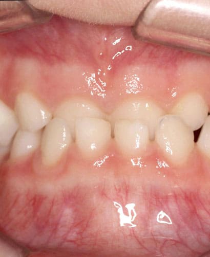 Mordida Invertida Anterior – 100% ONLINE