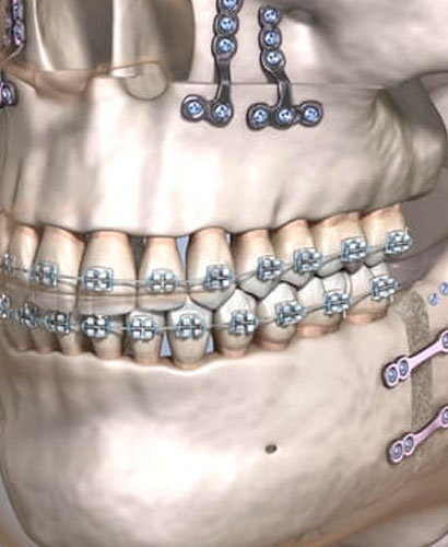 Ortodoncia y Cirugía Ortognática