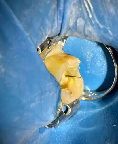 Diplomatura en Endodoncia – 100% ONLINE