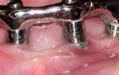 Periimplantitis – 100% ONLINE