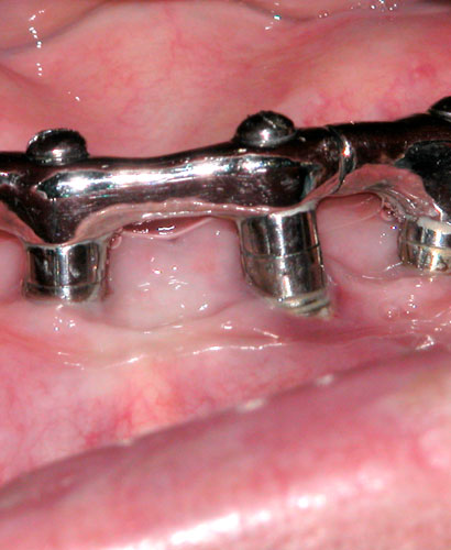 Periimplantitis – 100% ONLINE