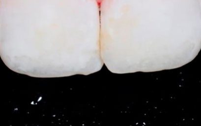 Porcelandas Dentales – 100% ONLINE