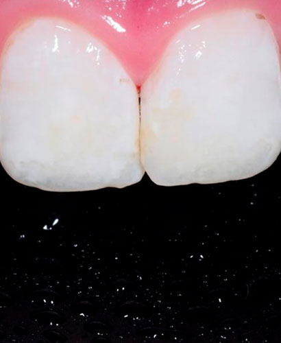 Porcelandas Dentales – 100% ONLINE