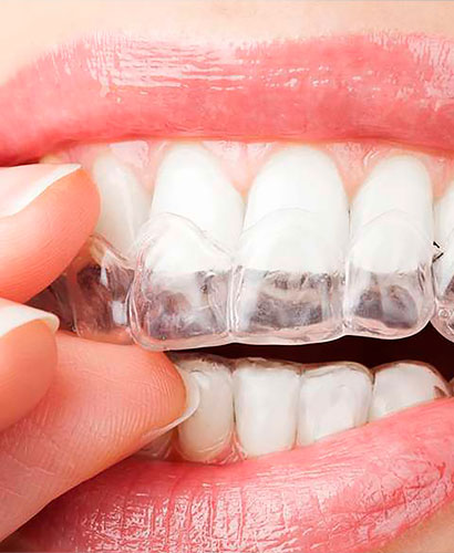 Ortodoncia Híbrida con Alineadores – 100% ONLINE