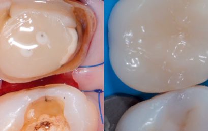 Diplomatura en Adhesión Periomimética – ONLINE + Presencial